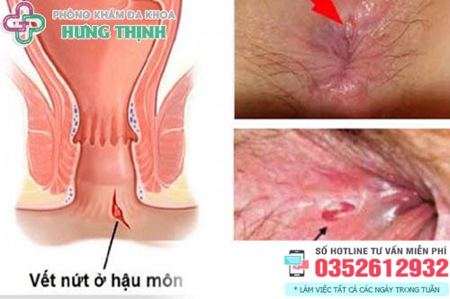 Thuốc Đặc Trị Nứt Kẽ Hậu Môn Gallery 1