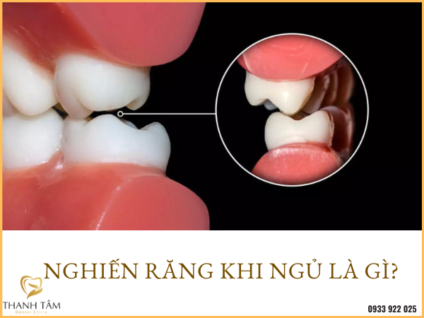 Cách Ngủ Không Nghiến Răng Gallery 1