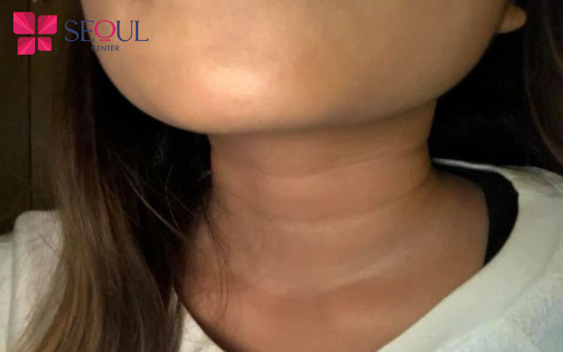 Cổ 3 Ngấn Nam: Bí quyết sở hữu vẻ ngoài nam tính và cuốn hút Gallery 1