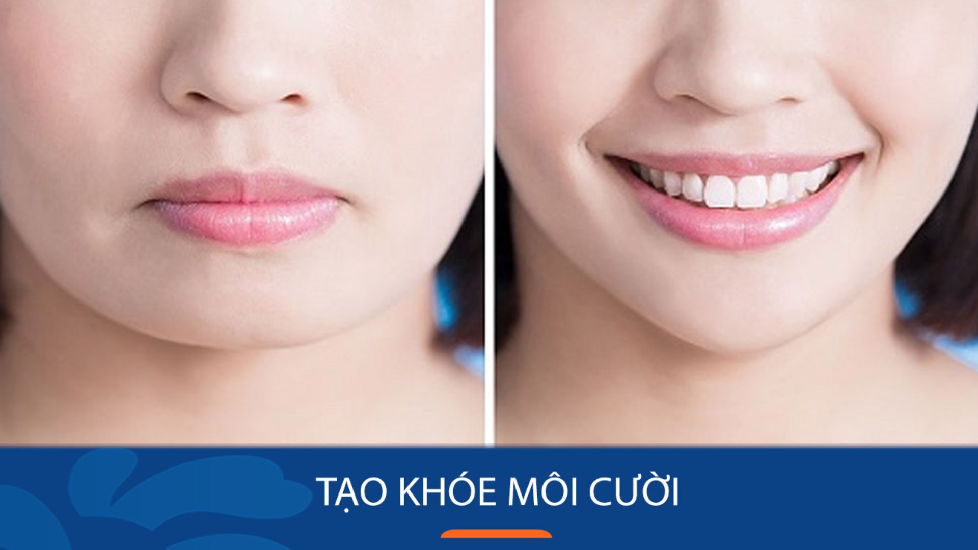 Tạo Khóe Môi Cười Tại Nhà Gallery 1