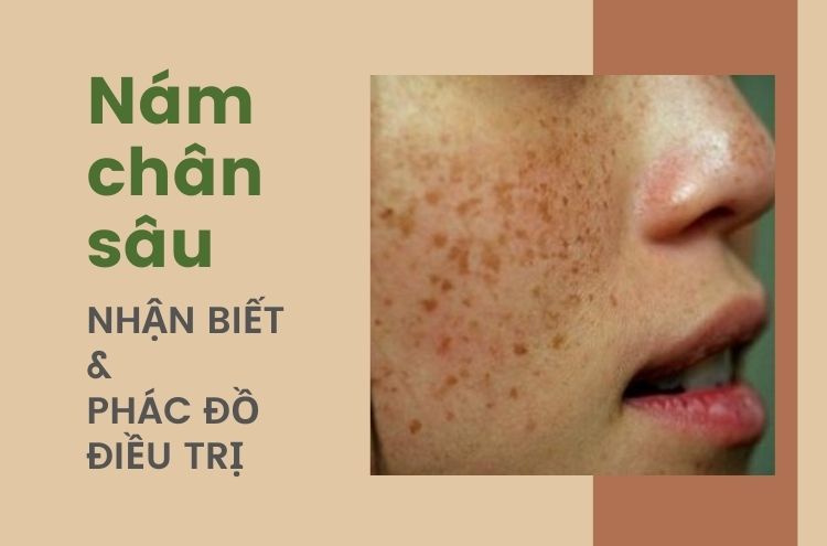Phác Đồ Điều Trị Nám Chân Sâu Hiệu Quả Gallery 1