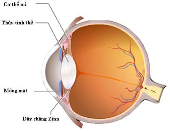 Thay Thủy Tinh Thể Mắt: Giải Pháp Khắc Phục Tật Khúc Xạ Hiệu Quả Gallery 1