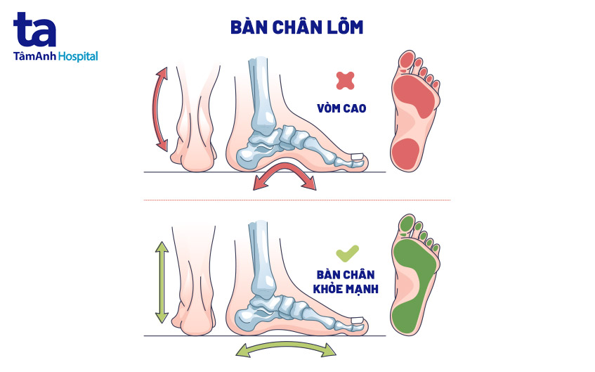 Tại Sao Bàn Chân Lõm Lại Khổ? Gallery 1