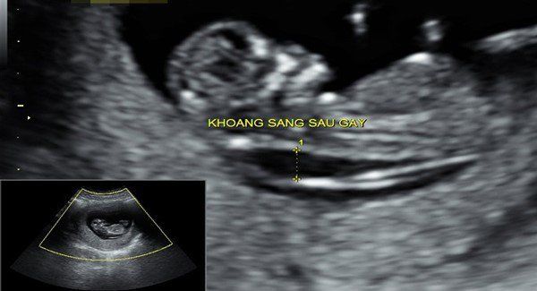 Khoảng sáng sau gáy bao nhiêu là bình thường? Gallery 1