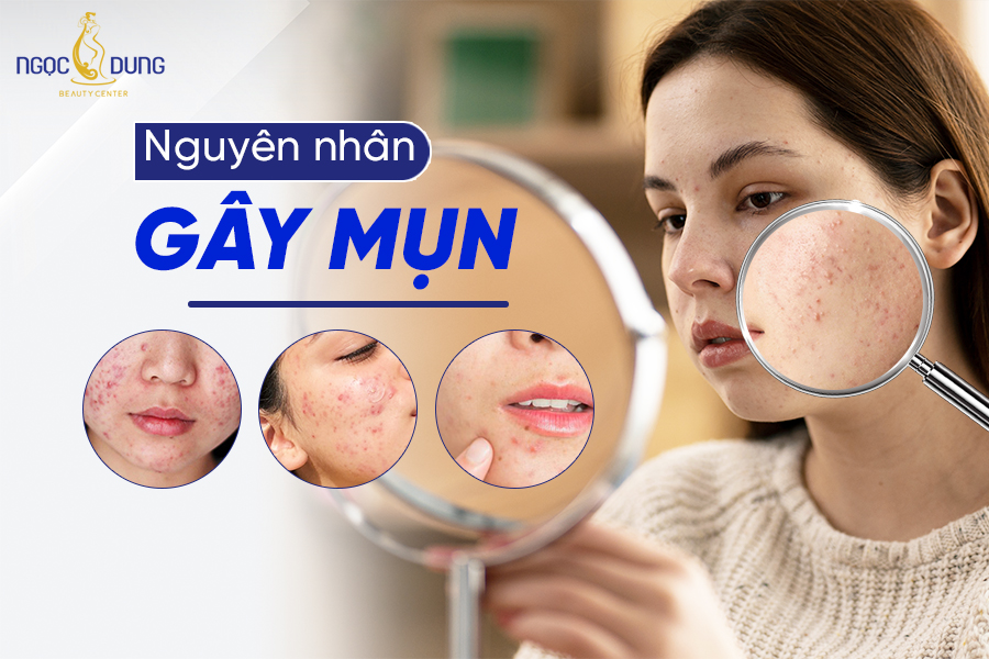 Cách Chăm Sóc Da Mụn Hiệu Quả Và Phòng Ngừa Mụn Trở Lại Gallery 1