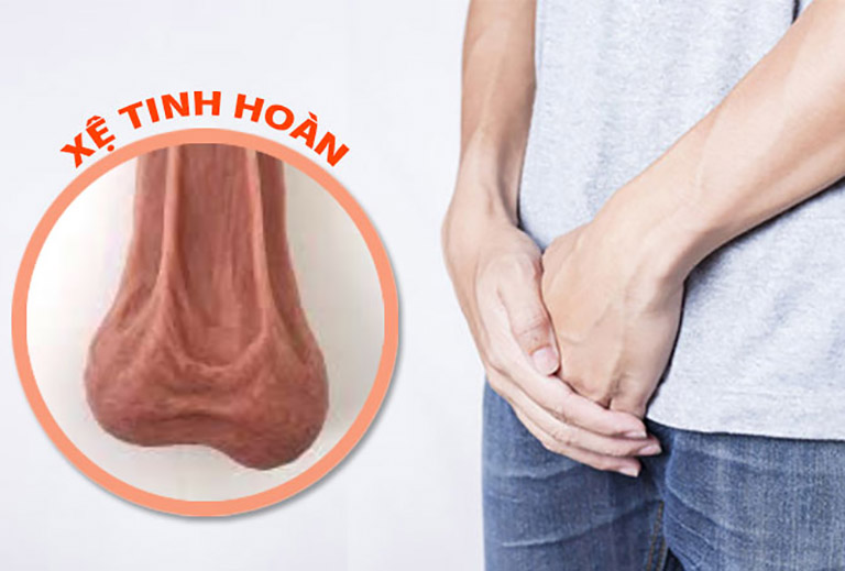 Tinh hoàn xệ có bị vô sinh không? Gallery 1