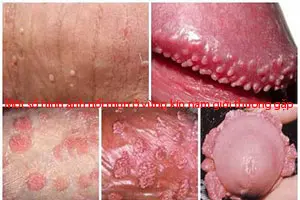 Cậu nhỏ nổi mụn: Nguyên nhân và cách điều trị