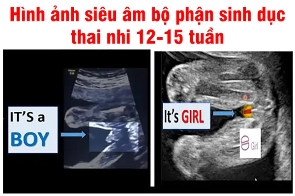 Hình ảnh siêu âm bộ phận sinh dục bé gái 12 tuần