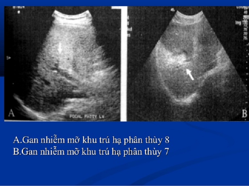 Thâm nhiễm mỡ trên siêu âm: Hình ảnh, chẩn đoán và điều trị Gallery 1