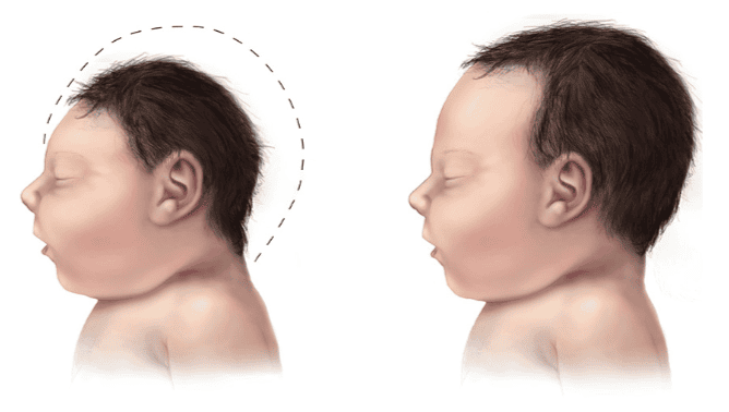 Hình ảnh trẻ em bị teo não