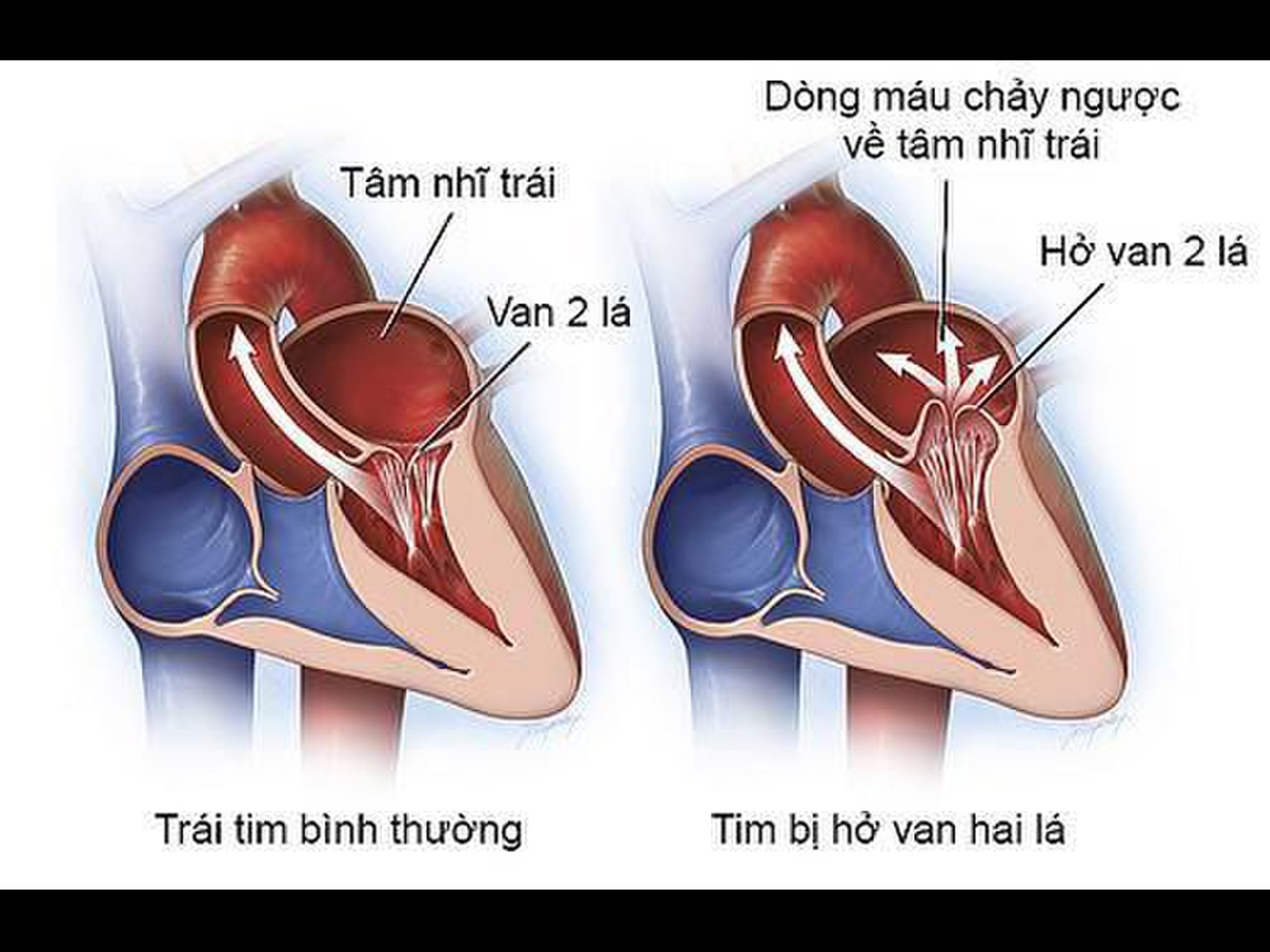 Hở Van 2 Lá Nhẹ