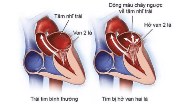 Hở van tim 2 lá 2/4 có nguy hiểm không?