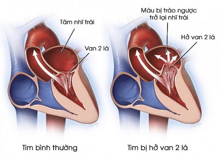 Hở van tim sinh lý có nguy hiểm không? Gallery 1