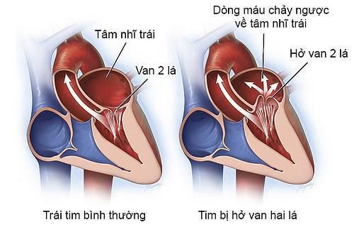 Heart Valve Disease