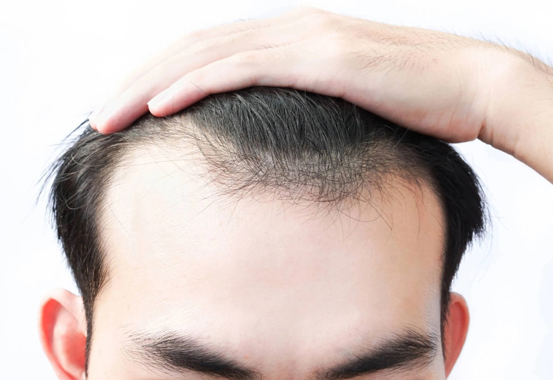 Hói đầu có di truyền không?