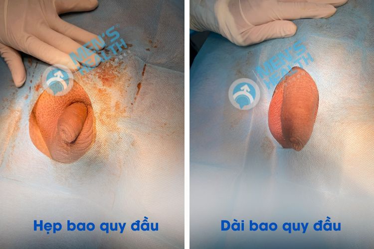 Hối Hận Khi Cắt Bao Quy Đầu