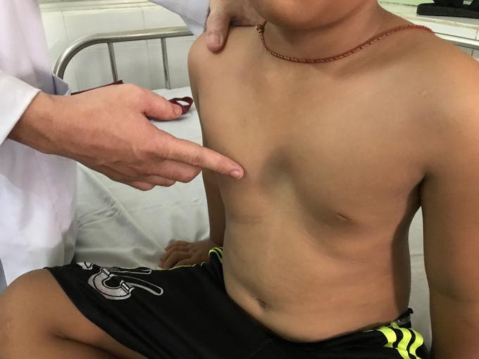 Hõm ức là gì? Gallery 2