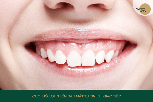 Tướng Người Cười Hở Lợi: Xem tướng số và vận mệnh Gallery 2