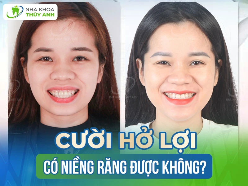 Người Cười Hở Hai Hàm Răng: Bí Quyết Nụ Cười Tỏa Sáng Gallery 2