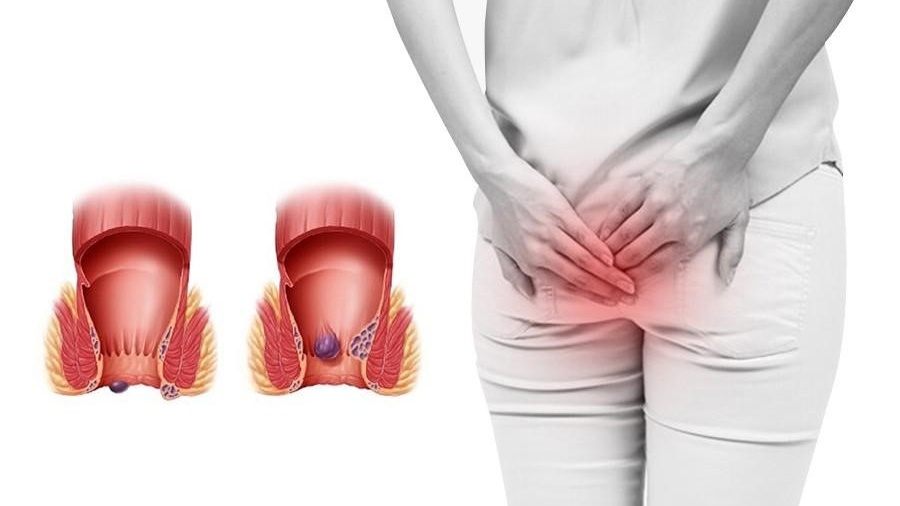 Khe mông có mùi: Nguyên nhân và cách khắc phục
