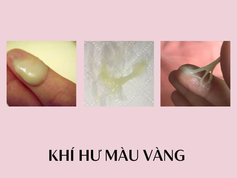 Khí hư màu vàng nhạt: Nguyên nhân và cách xử lý