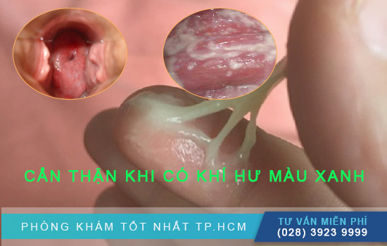 Khí hư màu xanh nhạt không mùi không ngứa: Nguyên nhân và cách xử trí