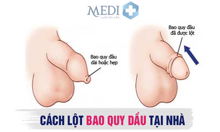 Khi Lột Bao Quy Đầu Xong Ta Nên Làm Gì?