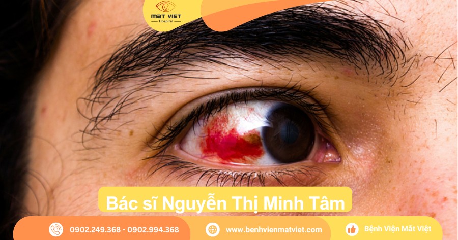 Lòng Trắng Mắt Có Đốm Trắng: Nguyên Nhân Và Cách Xử Lý Gallery 2