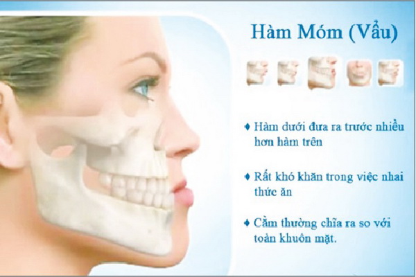 Làm Sao Để Hết Móm Tại Nhà? Gallery 2