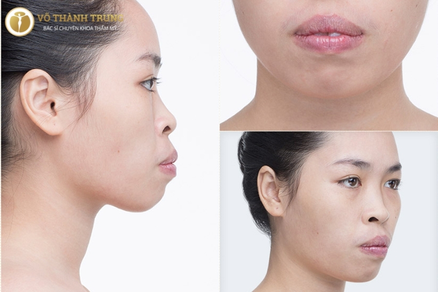 Mỏ nhọn phải làm sao? Gallery 2