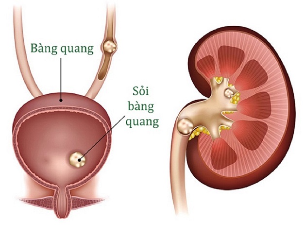 Cách Trị Sỏi Bàng Quang Tại Nhà Gallery 2