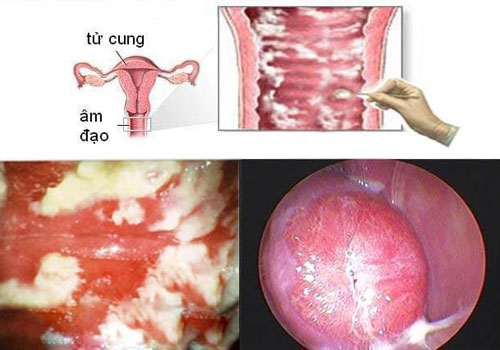 Bên trong vùng kín có mảng bám màu trắng Gallery 2