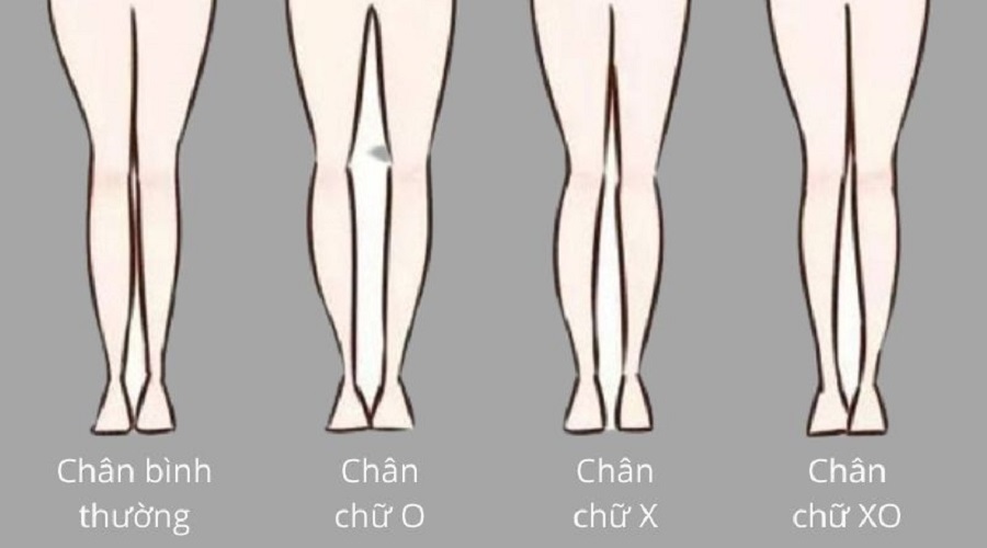 Cách Nhận Biết Chân Vòng Kiềng Ở Người Lớn Gallery 2
