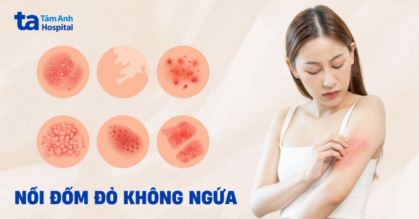 Da nổi mẩn đỏ từng mảng không ngứa: Nguyên nhân và cách xử lý Gallery 2