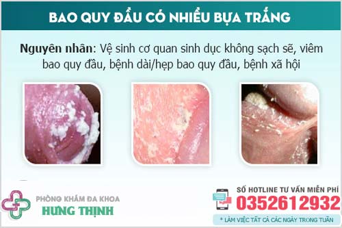 Dương vật có đốm trắng: Nguyên nhân và cách xử lý Gallery 2
