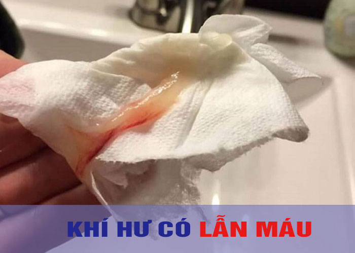 Huyết trắng kèm sợi máu: Nguyên nhân và cách xử lý Gallery 2