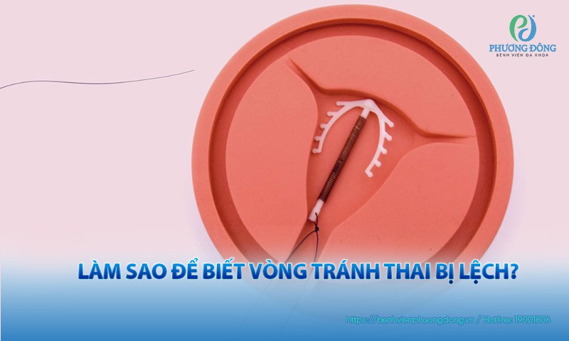 Làm sao để biết vòng tránh thai bị lệch? Gallery 2