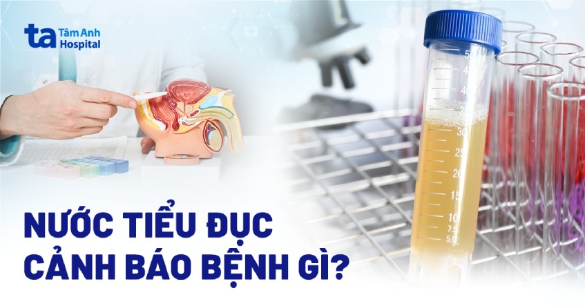 Nước Tiểu Đục Có Mùi Hôi: Nguyên Nhân Và Cách Khắc Phục Gallery 2