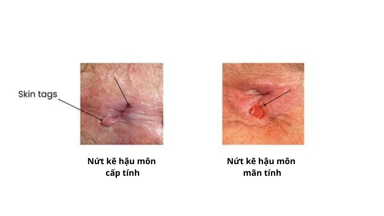 Rách hậu môn có nguy hiểm không? Gallery 2