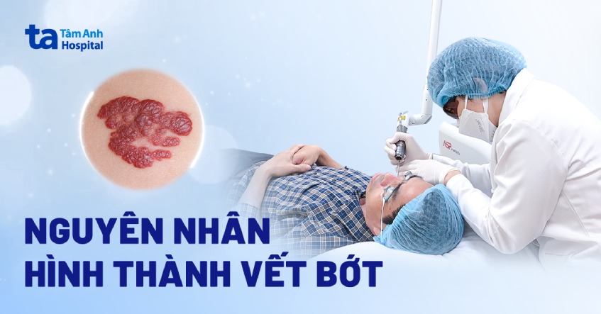 Vết bớt màu trắng có ý nghĩa gì? Gallery 1
