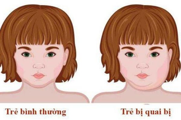 Trẻ bị sưng một bên má trái: Nguyên nhân và cách xử trí Gallery 2