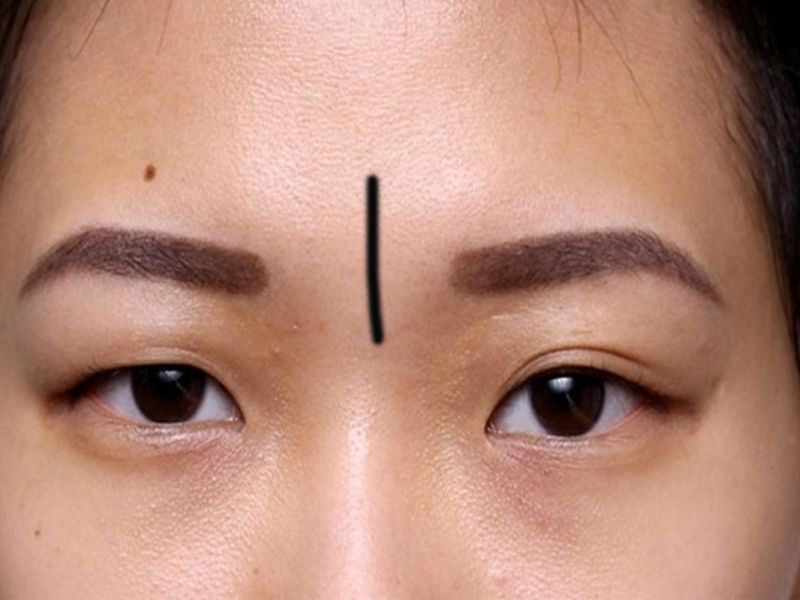 Trán Có Ấn Tròn Là Gì? Nguyên Nhân Và Cách Xử Lý Gallery 2