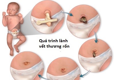 Có Nên Băng Rốn Sau Khi Rụng? Gallery 1