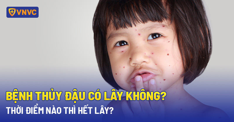Khi nào thủy đậu hết lây?