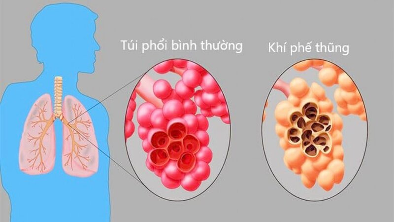 Khí Phế Thủng Là Gì?