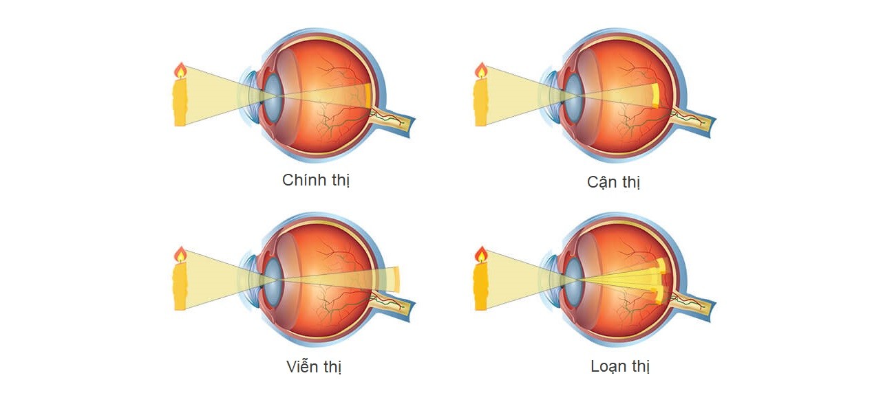 Khúc Mắt Là Gì? Nguyên Nhân Và Cách Điều Trị