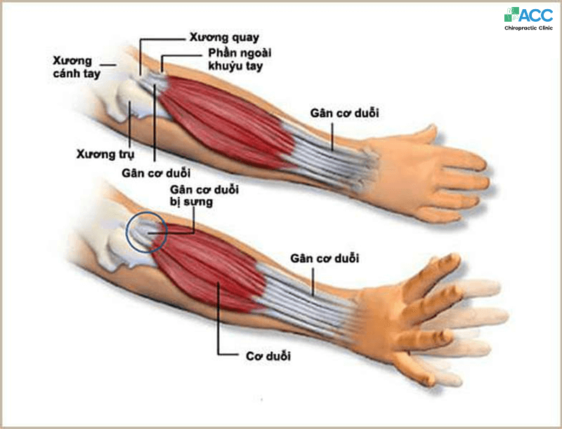 Khủyu Tay Là Gì?