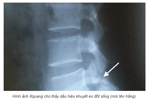 Khuyết Eo Đốt Sống: Nguyên Nhân, Triệu Chứng Và Điều Trị