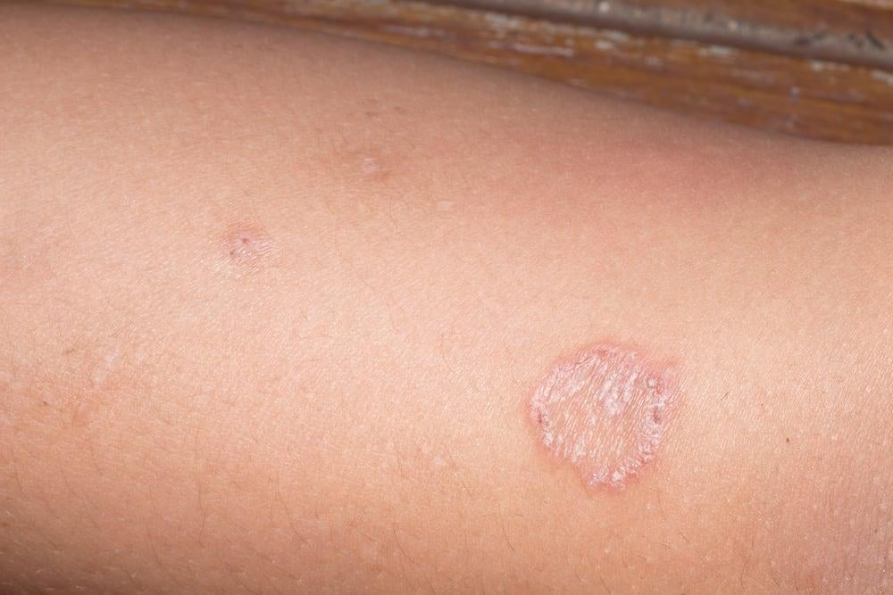 Lác Đồng Tiền Có Tự Khỏi?