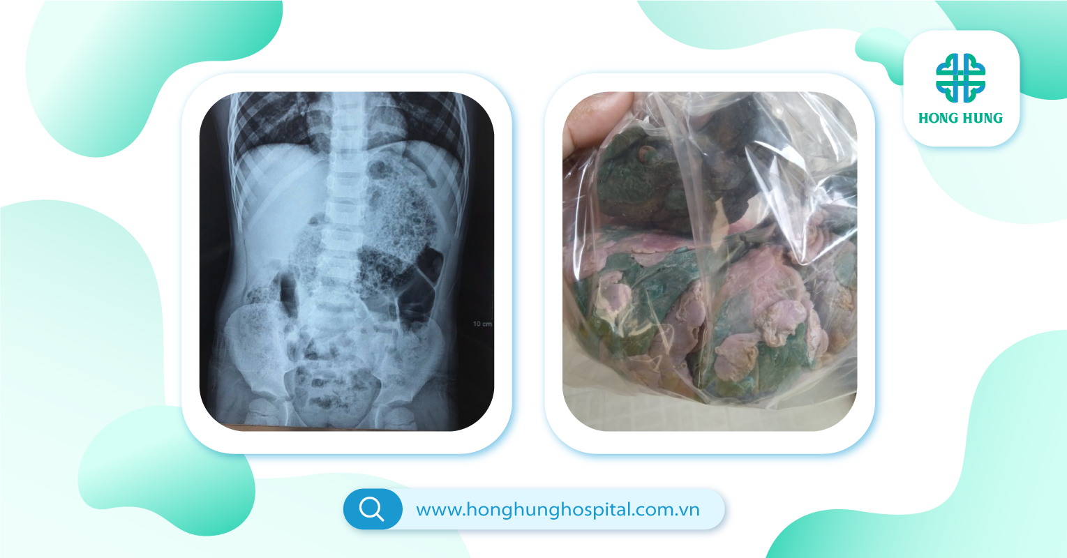Lỡ nuốt kẹo cao su phải làm sao? Gallery 1